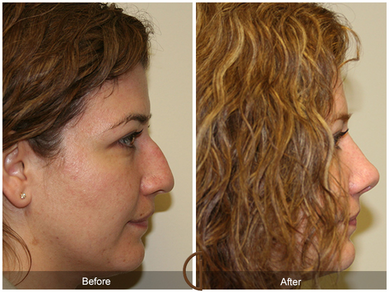 Female Rhinoplasty Before & After Image