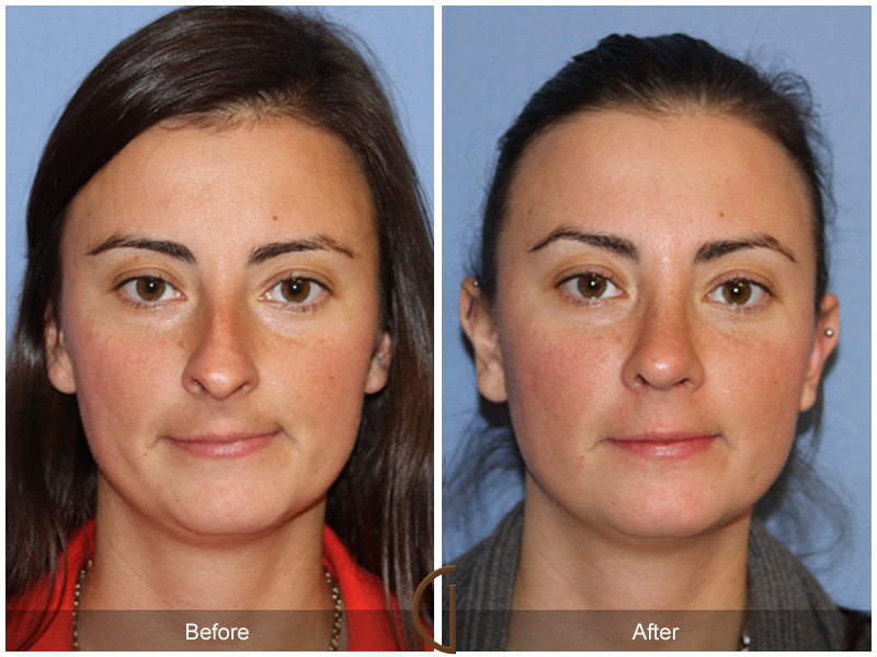 Female Rhinoplasty Before & After Image