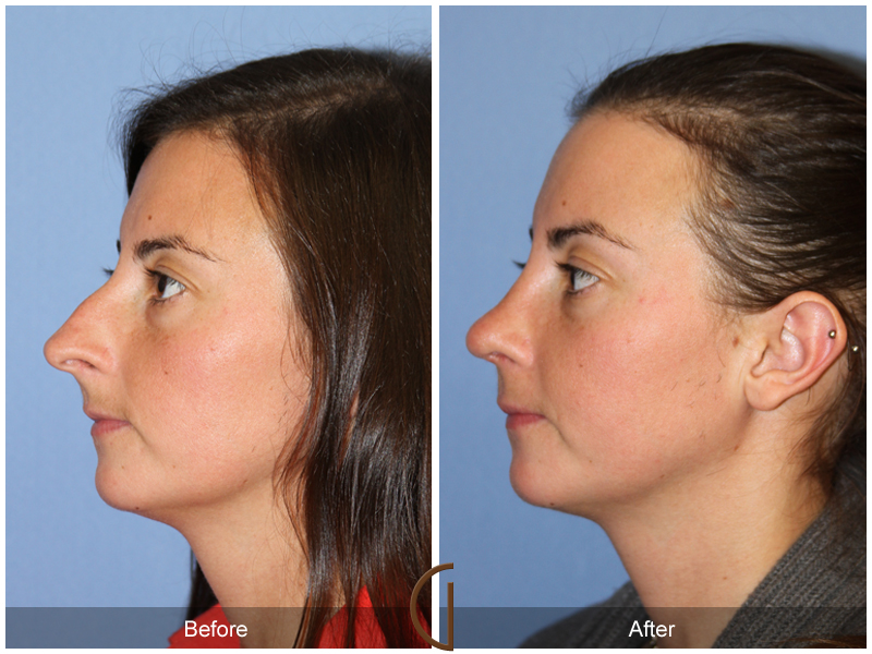 Female Rhinoplasty Before & After Image