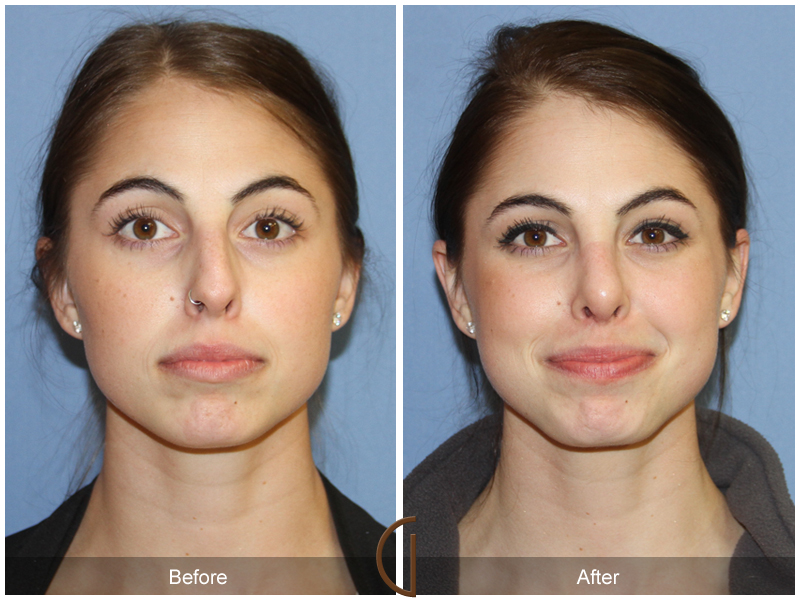 Female Rhinoplasty Before & After Image