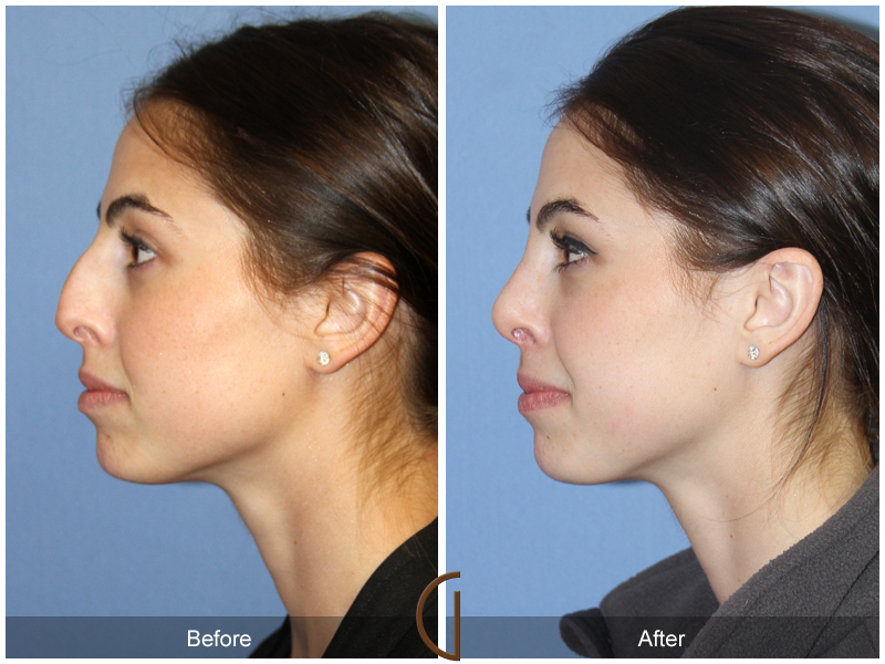 Female Rhinoplasty Before & After Image