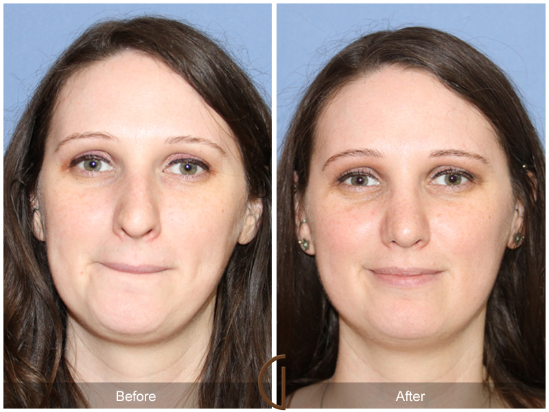 Female Rhinoplasty Before & After Image