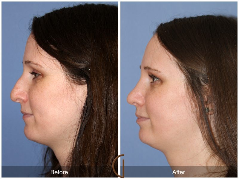 Female Rhinoplasty Before & After Image