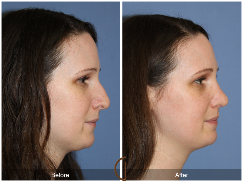 Female Rhinoplasty Before & After Image