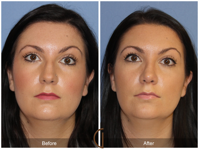 Female Rhinoplasty Before & After Image