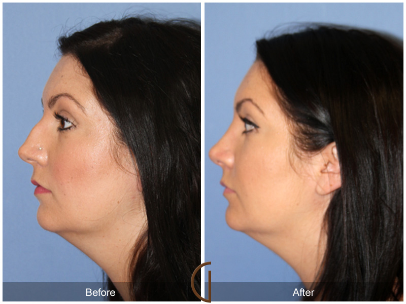 Female Rhinoplasty Before & After Image