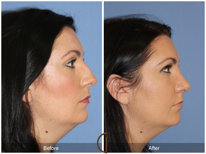 Female Rhinoplasty Before & After Image