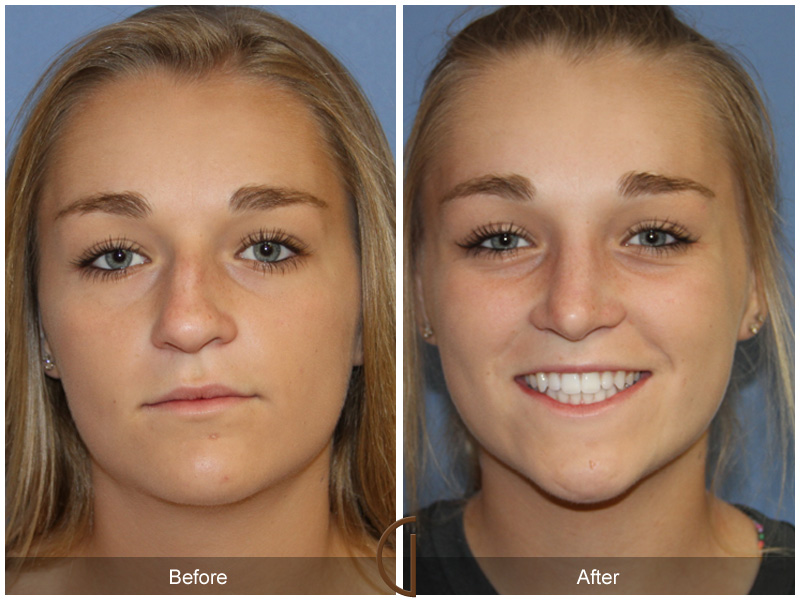 Female Rhinoplasty Before & After Image