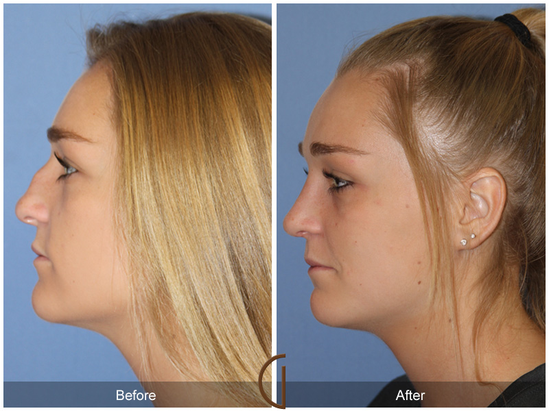 Female Rhinoplasty Before & After Image