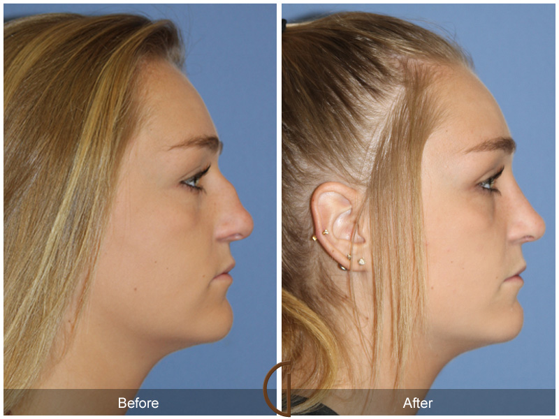 Female Rhinoplasty Before & After Image