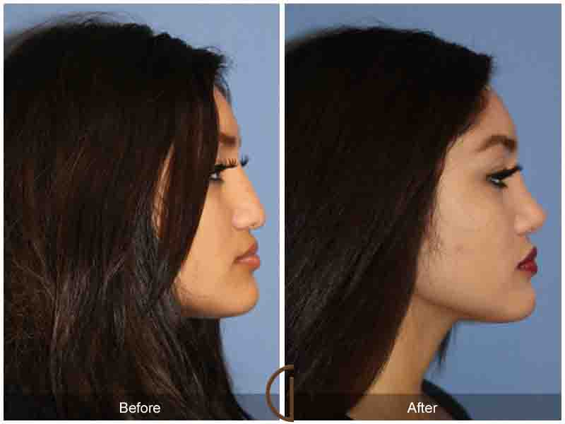 Female Rhinoplasty Before & After Image