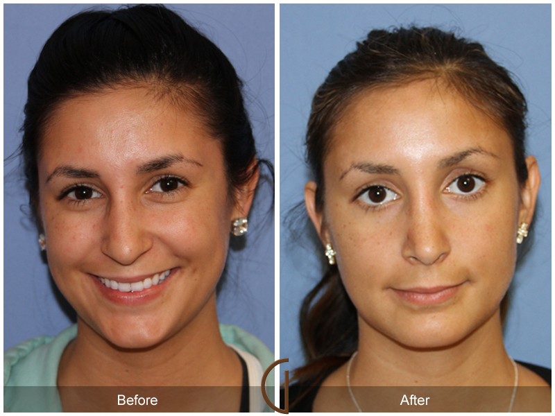 Female Rhinoplasty Before & After Image