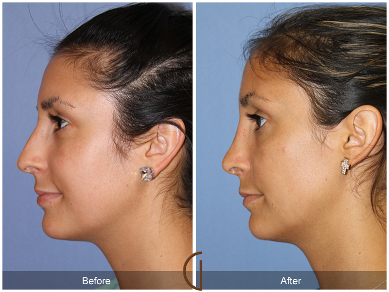 Female Rhinoplasty Before & After Image