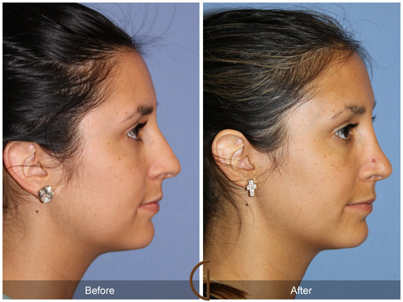 Female Rhinoplasty Before & After Image