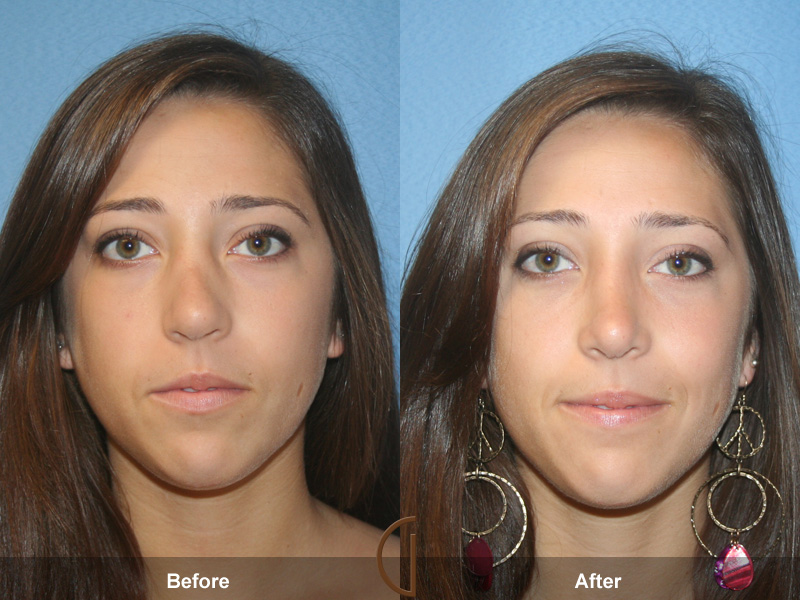 Female Rhinoplasty Before & After Image