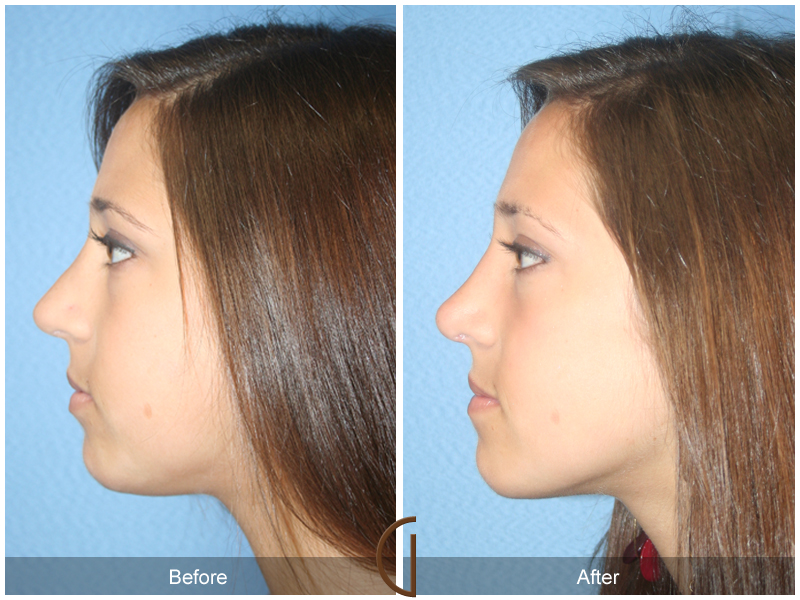 Female Rhinoplasty Before & After Image