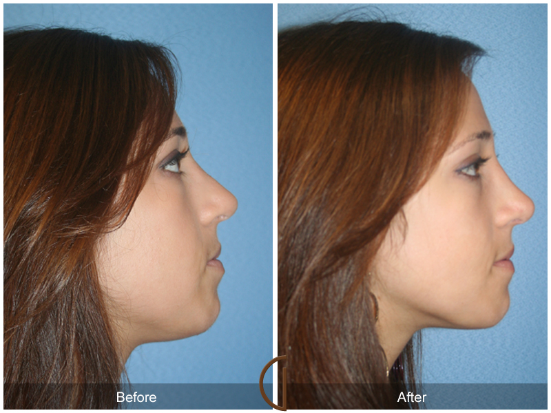 Female Rhinoplasty Before & After Image