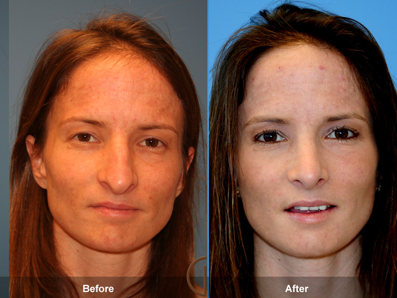 Female Rhinoplasty Before & After Image