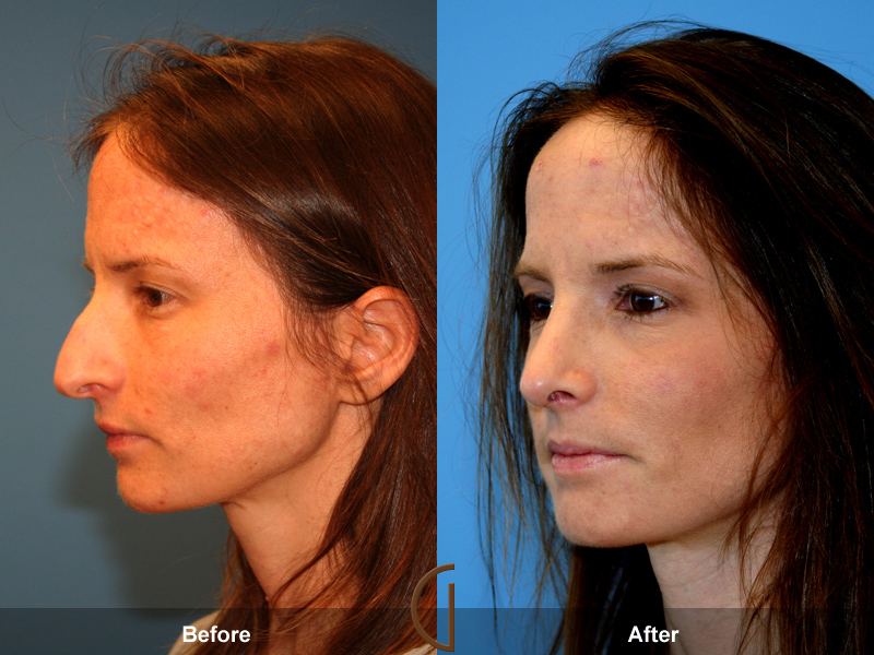 Female Rhinoplasty Before & After Image