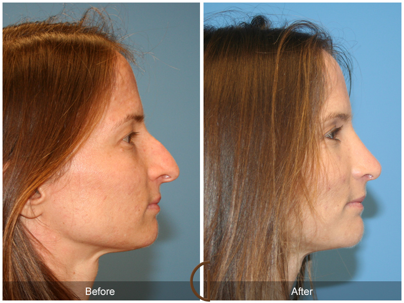 Female Rhinoplasty Before & After Image