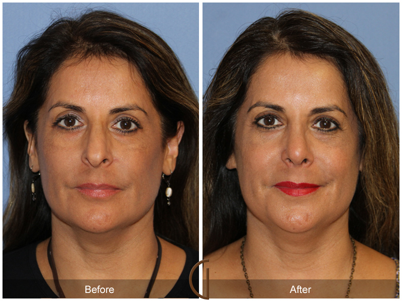 Female Rhinoplasty Before & After Image