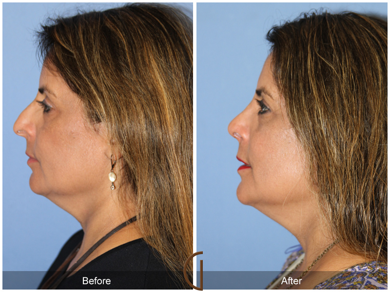 Female Rhinoplasty Before & After Image