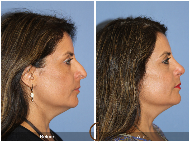 Female Rhinoplasty Before & After Image