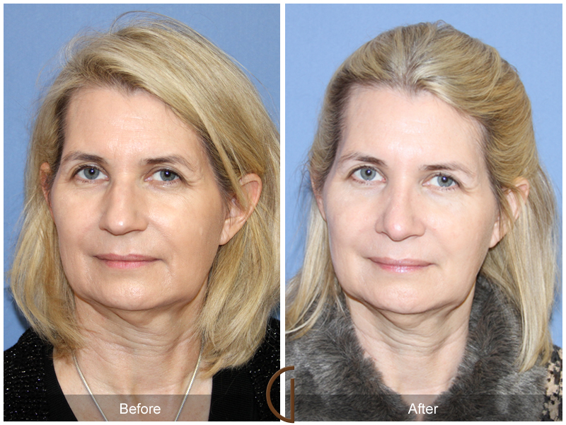 Female Rhinoplasty Before & After Image