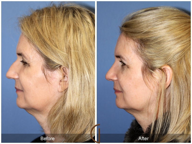 Female Rhinoplasty Before & After Image