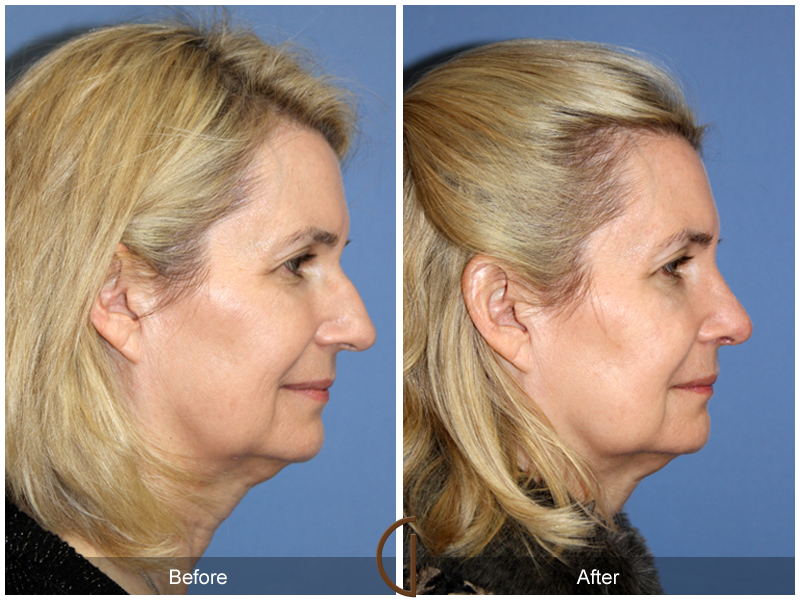 Female Rhinoplasty Before & After Image