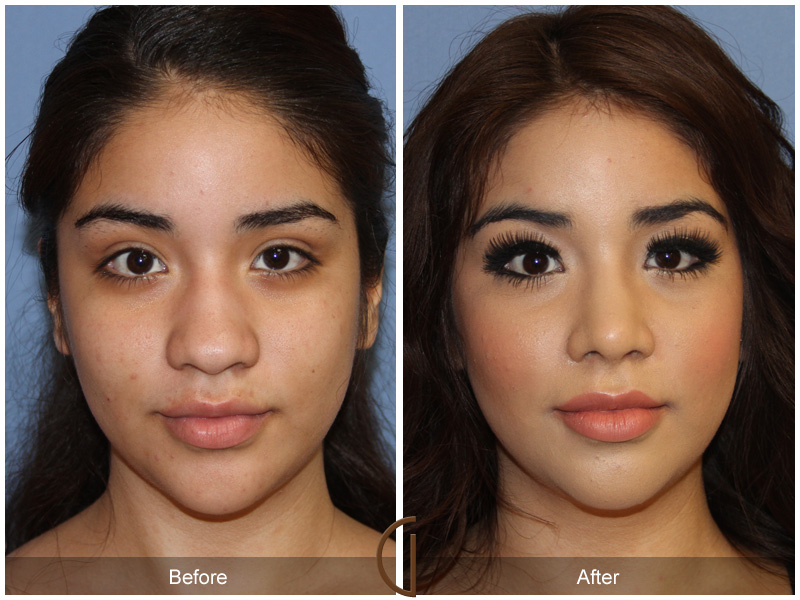 Female Rhinoplasty Before & After Image