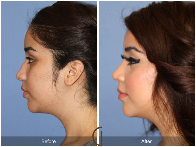 Female Rhinoplasty Before & After Image