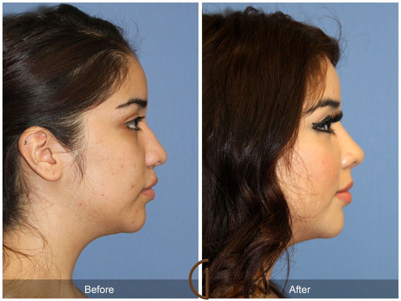 Female Rhinoplasty Before & After Image