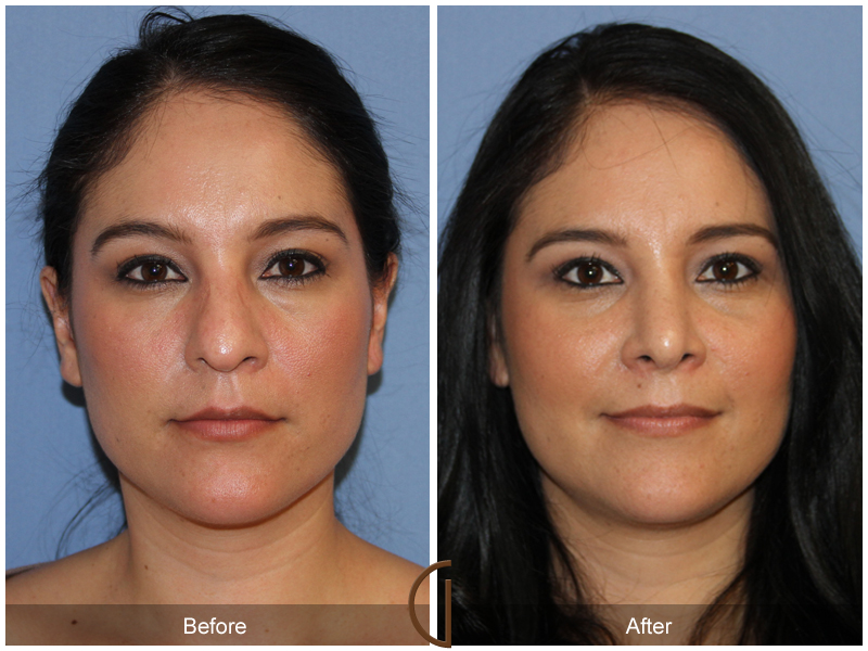 Female Rhinoplasty Before & After Image