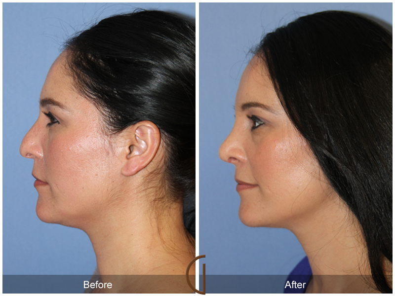 Female Rhinoplasty Before & After Image