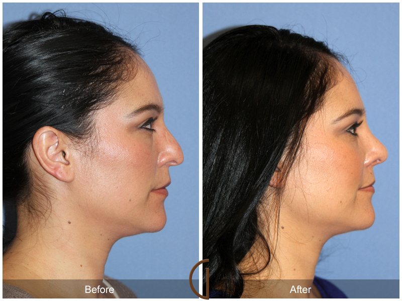 Female Rhinoplasty Before & After Image