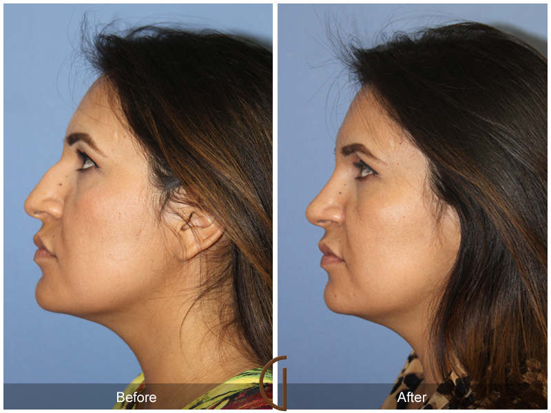 Female Rhinoplasty Before & After Image