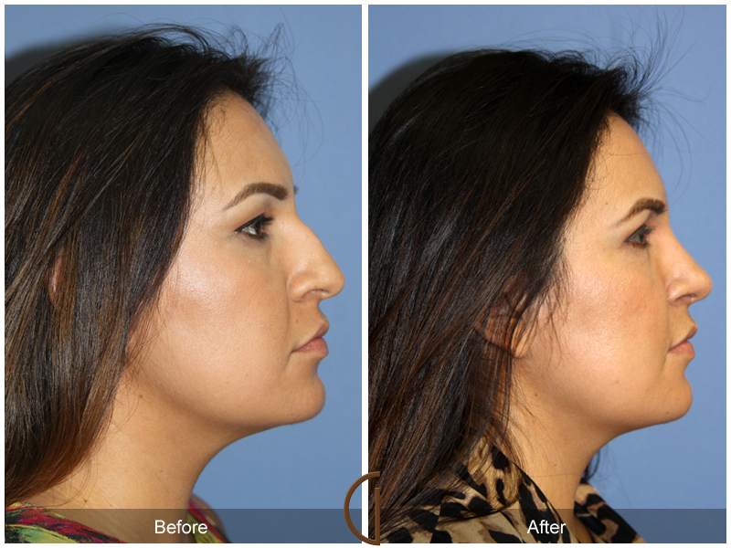 Female Rhinoplasty Before & After Image