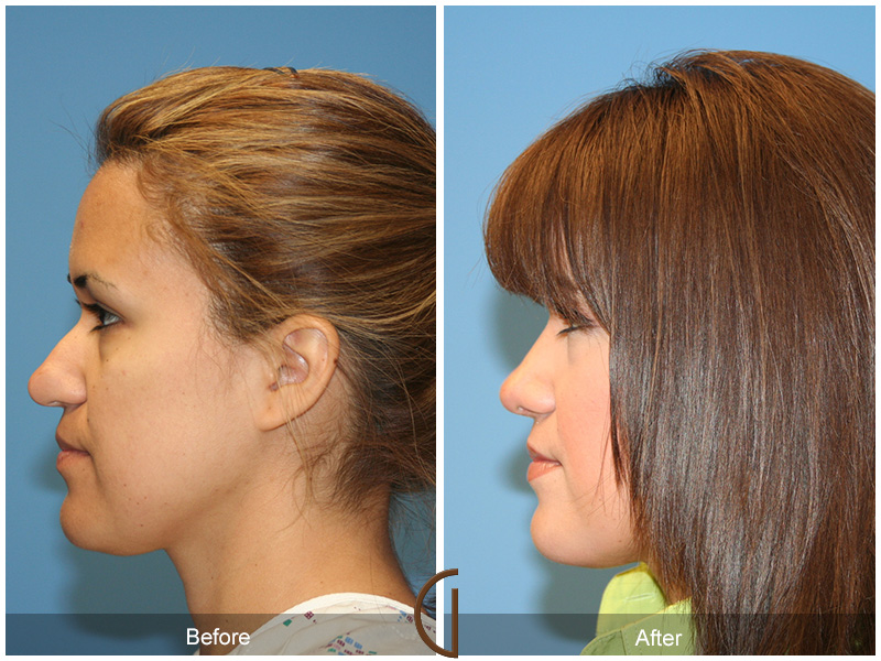 Female Rhinoplasty Before & After Image