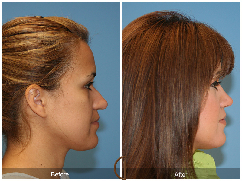 Female Rhinoplasty Before & After Image