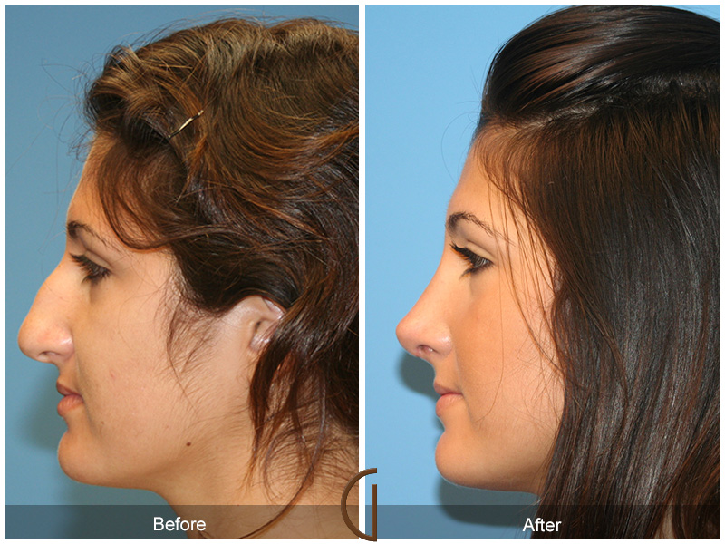 Female Rhinoplasty Before & After Image