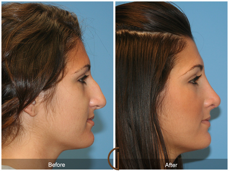 Female Rhinoplasty Before & After Image