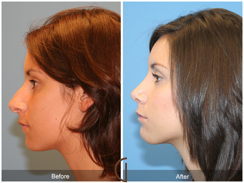 Female Rhinoplasty Before & After Image