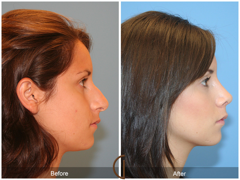 Female Rhinoplasty Before & After Image