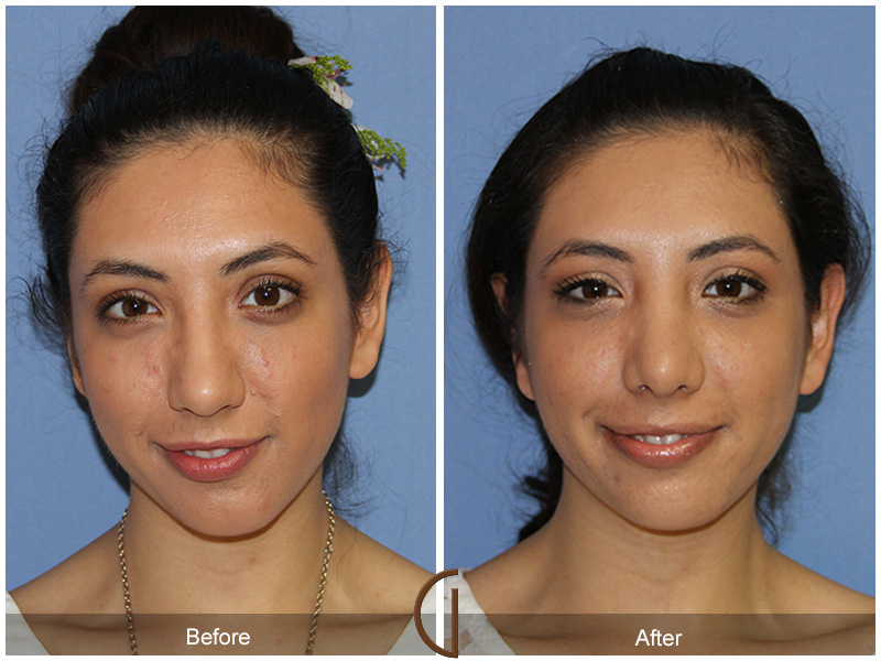 Female Rhinoplasty Before & After Image