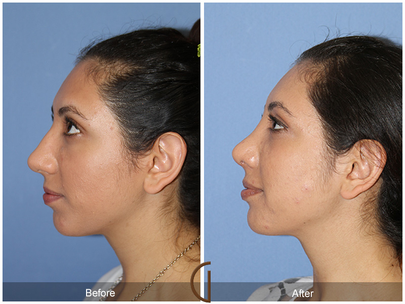 Female Rhinoplasty Before & After Image