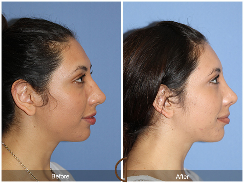 Female Rhinoplasty Before & After Image