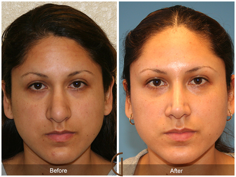 Female Rhinoplasty Before & After Image