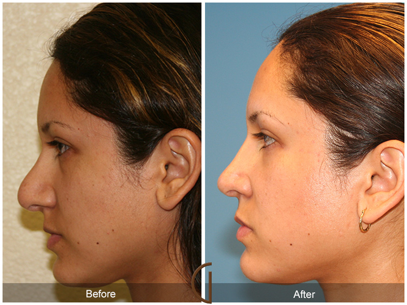 Female Rhinoplasty Before & After Image