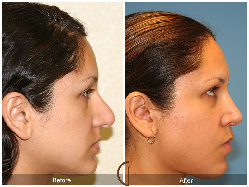 Female Rhinoplasty Before & After Image